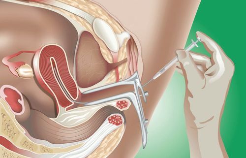 Vì sao nên kiêng quan hệ tình dục trước khi bơm tinh trùng (IUI)?