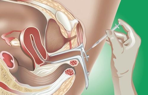 Why should one abstain from sex before intrauterine insemination (IUI)?