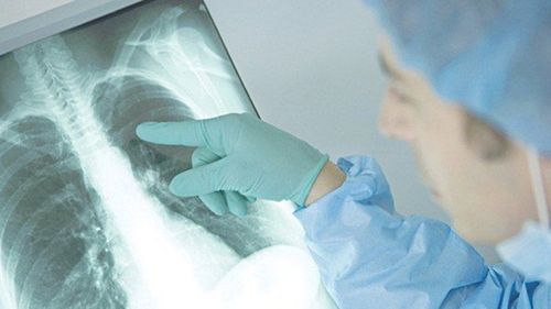 Chụp X-Quang tim phổi xuất hiện đám mờ trên phổi có nguy hiểm không?