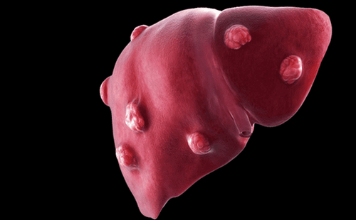 Benign liver tumors in children: Classification, symptoms, treatment