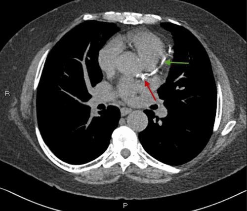 
Chụp CT scan giúp chẩn đoán, đánh giá tình trạng vôi hóa mạch vành
