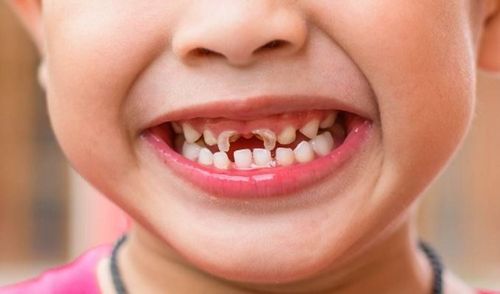 Trẻ sún răng có phải do thiếu canxi không?
