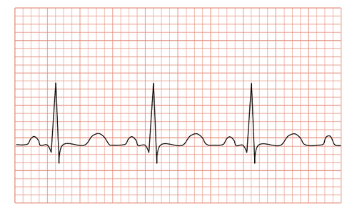 Shape and mechanism of wave formation on electrocardiogram