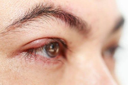 
Eyelid edema
