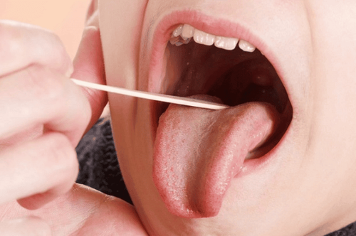 Những điều cần biết về viêm amidan lưỡi
