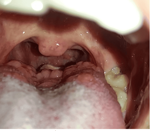 
Image of lingual tonsillitis
