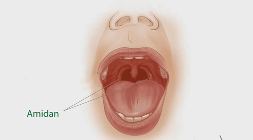 Bệnh polyp amidan là căn bệnh như thế nào?