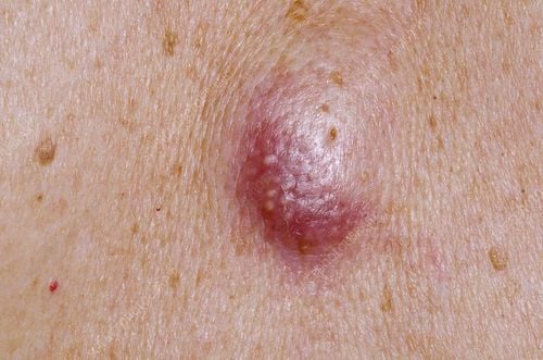 Epidermoid cyst, sebaceous cyst