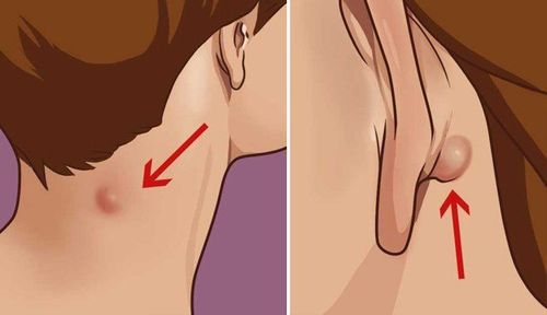 
U nang Epidermoid thường xuất hiện vùng đầu, mặt và cổ
