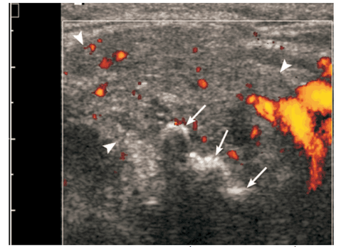 Role of salivary gland ultrasound in diagnosis