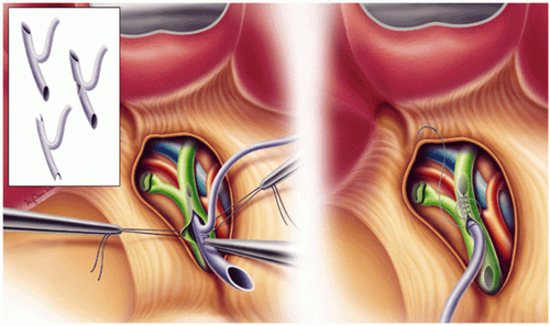 X-ray of the bile duct through the Kehr . duct