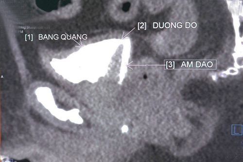 What is a fistula x-ray?