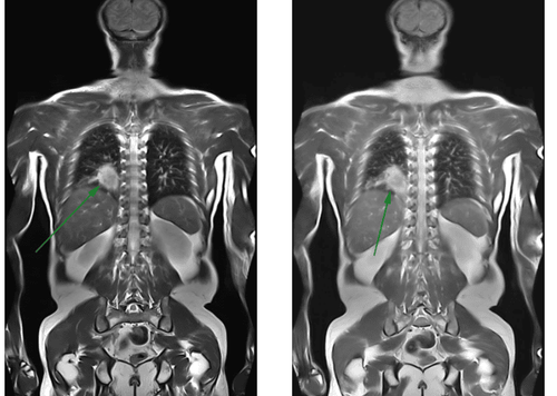 
MRI toàn thân phát hiện khối U phổi
