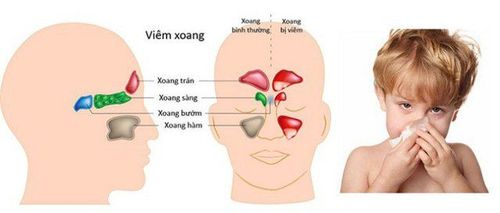 
Vị trí các xoang của trẻ
