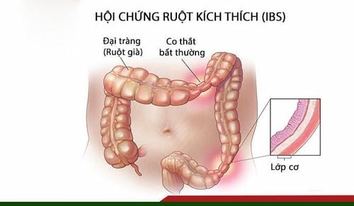 
Hội chứng ruột kích thích (IBS)
