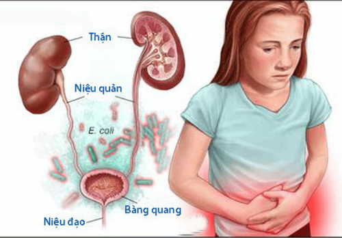 Urinary tract infections and urolithiasis