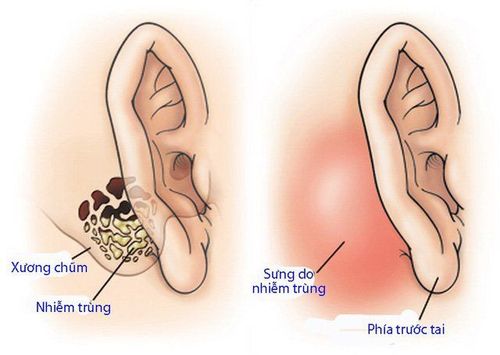 
Vị trí xương chũm nhiễm trùng
