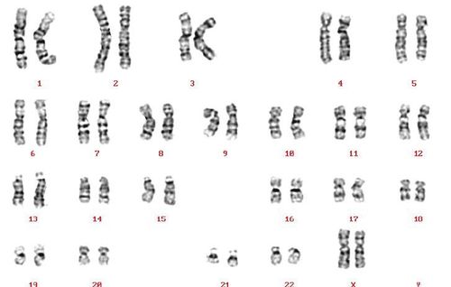 
Karyotype bình thường ở nữ giới (Reproduced courtesy of Human Genome Centre, Universiti Sains Malaysia, Malaysia)
