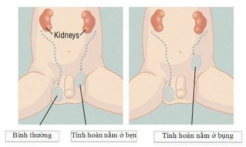 Spring testicles in male children