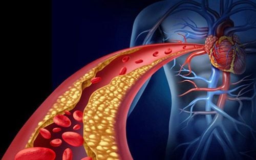 Nguy cơ bệnh tim ở người bị rối loạn lipid máu