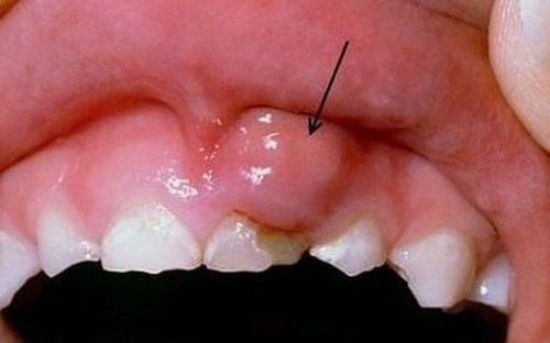 Sưng nướu chân răng kèm ê buốt biểu hiện bệnh gì?