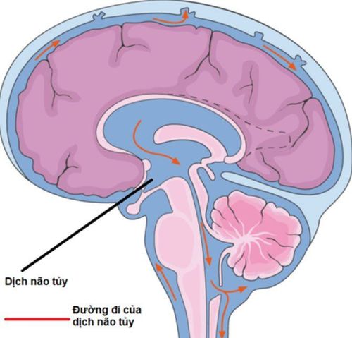 Gây mê mask thanh quản mổ nội soi phá nang màng nhện dịch não tủy