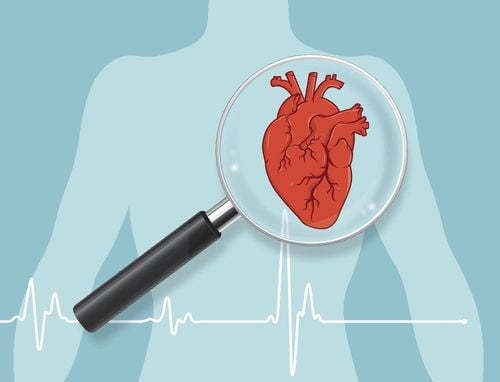 Can thiệp mạch vành khi nhồi máu cơ tim cấp: Hướng dẫn chăm sóc bệnh nhân