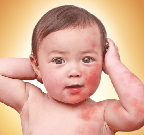 Nguyên nhân khiến da trẻ sơ sinh bị nổi các hột đỏ và cách khắc phục