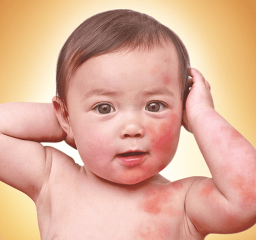 Rashes in babies: causes, treatment