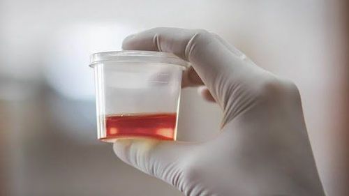 What are the common causes of hematuria in children?