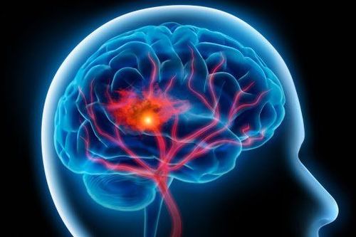 Surgery to reduce pressure in hemorrhagic stroke