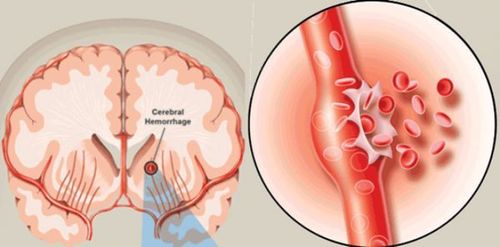 
Người bệnh bị đột quỵ nên sử dụng spironolactone không đi kèm với thuốc tránh thai
