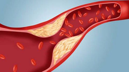 The relationship between increased cholesterol and atherosclerosis