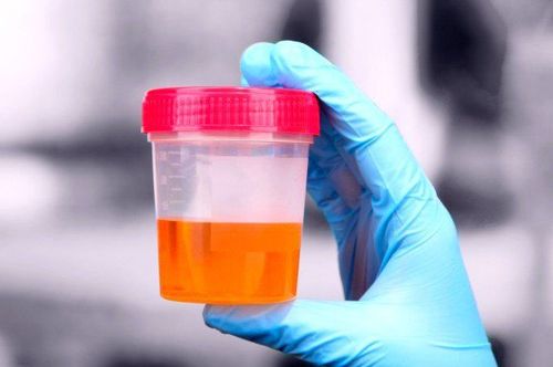 Why is urine reddish brown?