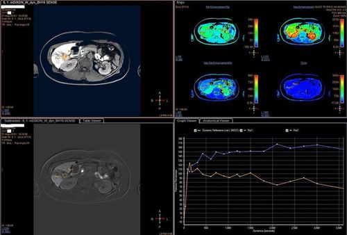 Procedure for liver magnetic resonance imaging with tissue-specific contrast agents