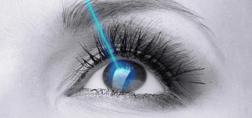 Mổ lasik chữa cận thị có an toàn không?