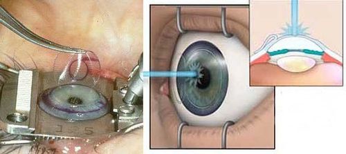 
Phương pháp mổ mắt bằng lasik đem lại nhiều ưu điểm vượt trội cho người bệnh
