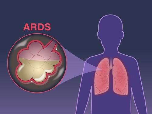 Severe respiratory distress syndrome in adults