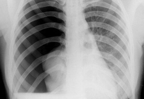 X-ray picture of pneumothorax