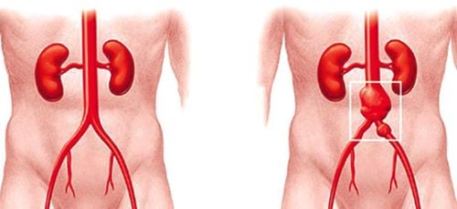 Emergency abdominal aortic aneurysm