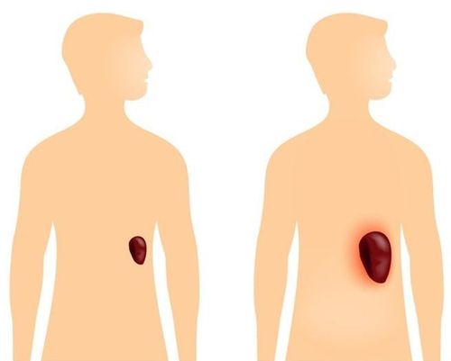 Enlarged spleen: Causes, symptoms and treatment