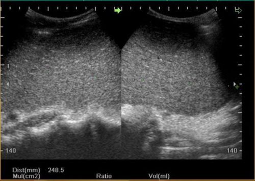 Steps to perform ultrasound diagnosis of spleen disease