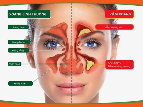 
Vị trí xoang bướm
