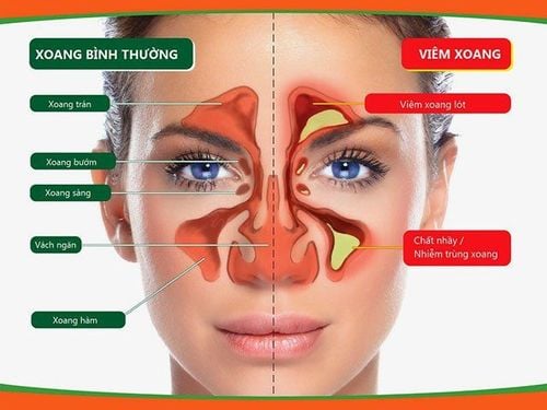 
Sphenoid sinus location
