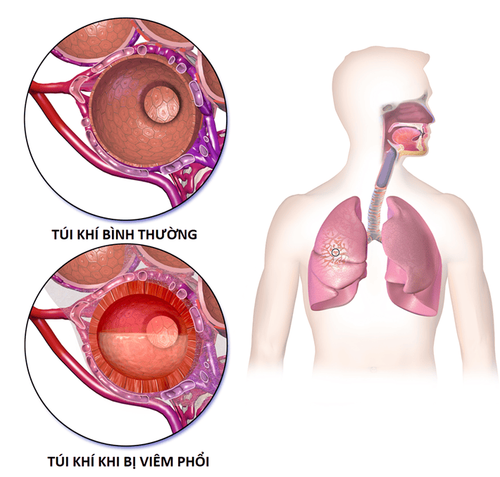 
Viêm phổi là một trong các nguyên nhân gây giảm oxy máu động mạch và thiếu oxy tổ chức
