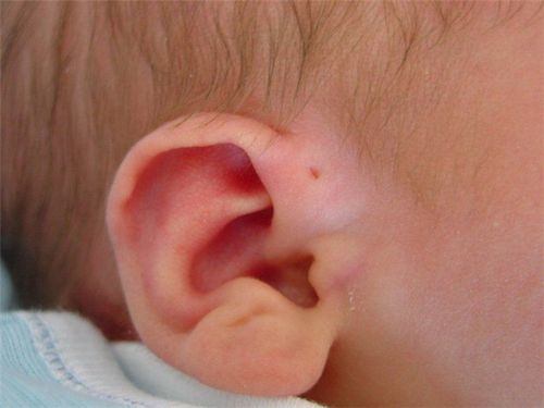 Trẻ 10 tháng tuổi bị sưng lỗ rò luân nhĩ điều trị như thế nào?