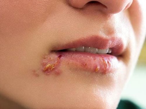 Giời leo ở môi miệng nên điều trị như thế nào?