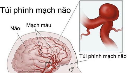 Các vị trí thường gặp của túi phình mạch máu não