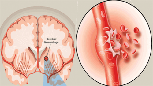 The role of tomography assessment of cerebral bleeding after surgery