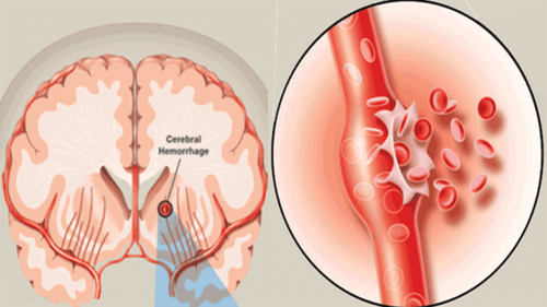 Vai trò của chụp cắt lớp đánh giá chảy máu não sau mổ